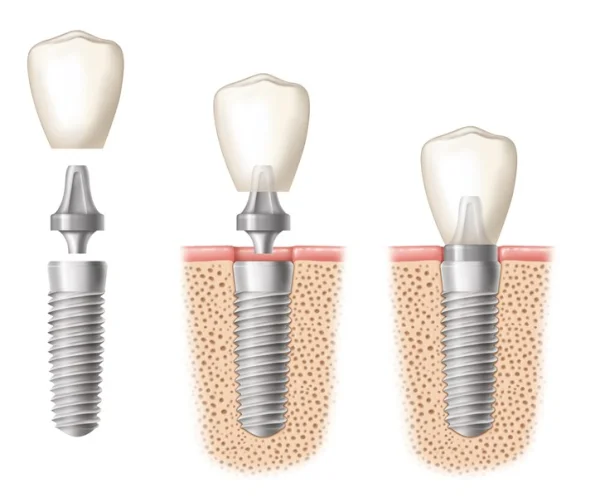 Illustrazione di un impianto dentale in titanio con moncone e corona