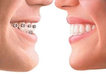 Confronto tra denti con apparecchio e denti allineati